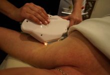 Laser Hair Removal – Close up