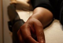 Acupuncture